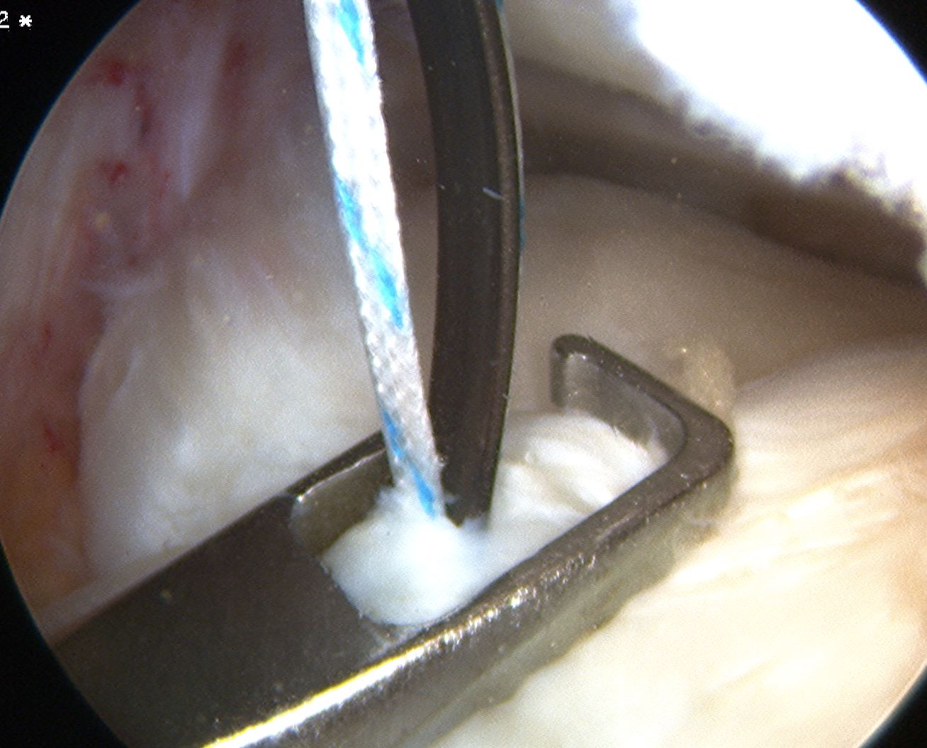 Anterior Horn Tear Suture Passage 2